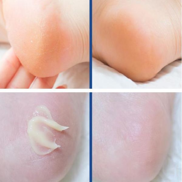 Купити Пом'якшувальний пілінг-крем для ніг MEDI-PEEL EGF Scaling Moisture Foot Cream на LovelyBunny.com.ua